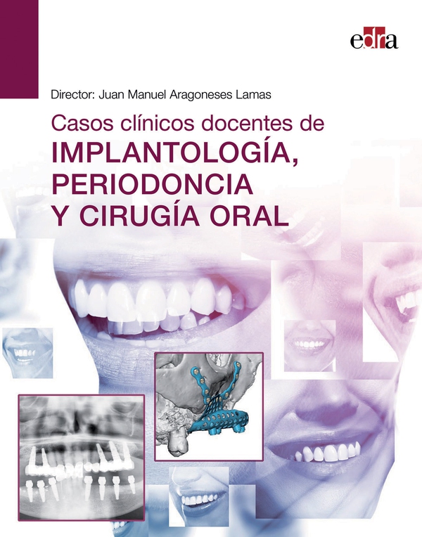 Casos clínicos docentes de IMPLANTOLOGÍA, PERIODONCIA Y CIRUGÍA ORAL - Librerie.coop Casos clínicos docentes de IMPLANTOLOGÍA, PERIODONCIA Y CIRUGÍA ORAL - Librerie.coop