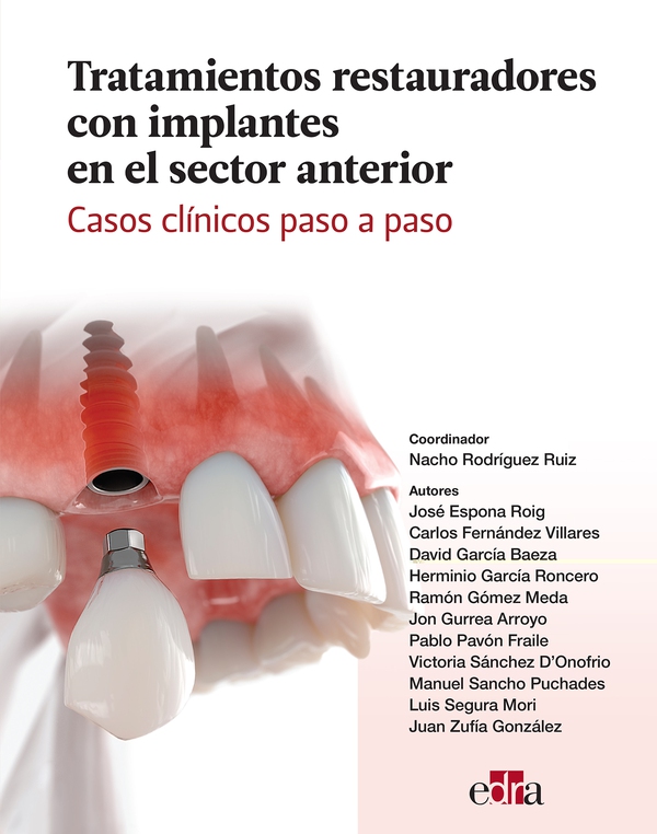 Tratamientos restauradores con implantes en el sector anterior. Casos clínicos paso a paso - Librerie.coop Tratamientos restauradores con implantes en el sector anterior. Casos clínicos paso a paso - Librerie.coop