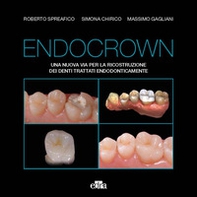 Endocrown. Una nuova via per la ricostruzione dei denti trattati endodonticamente - Librerie.coop