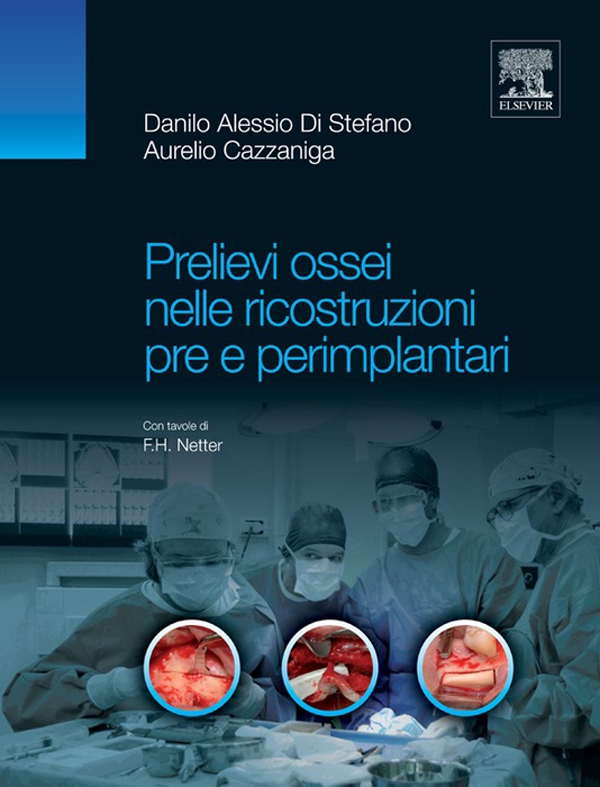 Prelievi ossei nelle ricostruzioni pre e perimplantari - Librerie.coop Prelievi ossei nelle ricostruzioni pre e perimplantari - Librerie.coop