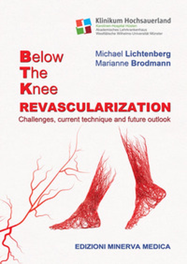 Below the knee revascularization. Challenges, current technique and future outlook - Librerie.coop Below the knee revascularization. Challenges, current technique and future outlook - Librerie.coop