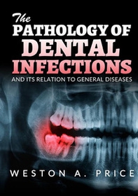The pathology of dental infections and its relation to general diseases - Librerie.coop
